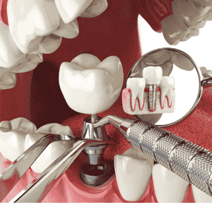 Dental implants in hayathnagr