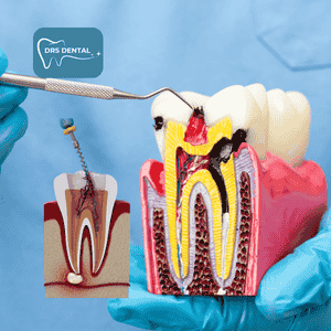 Painless Root Canal in hayathnagr