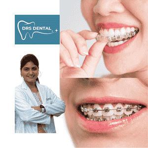 Invisible Braces in Hayathnagar