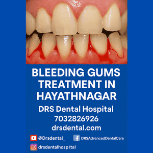 Bleeding Gums Treatment in Hayathnagar