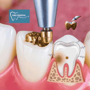 Cavity Filling in Hayathnagar