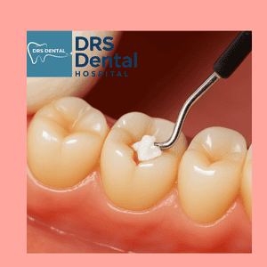 Dental Fillings in Hayathnagar