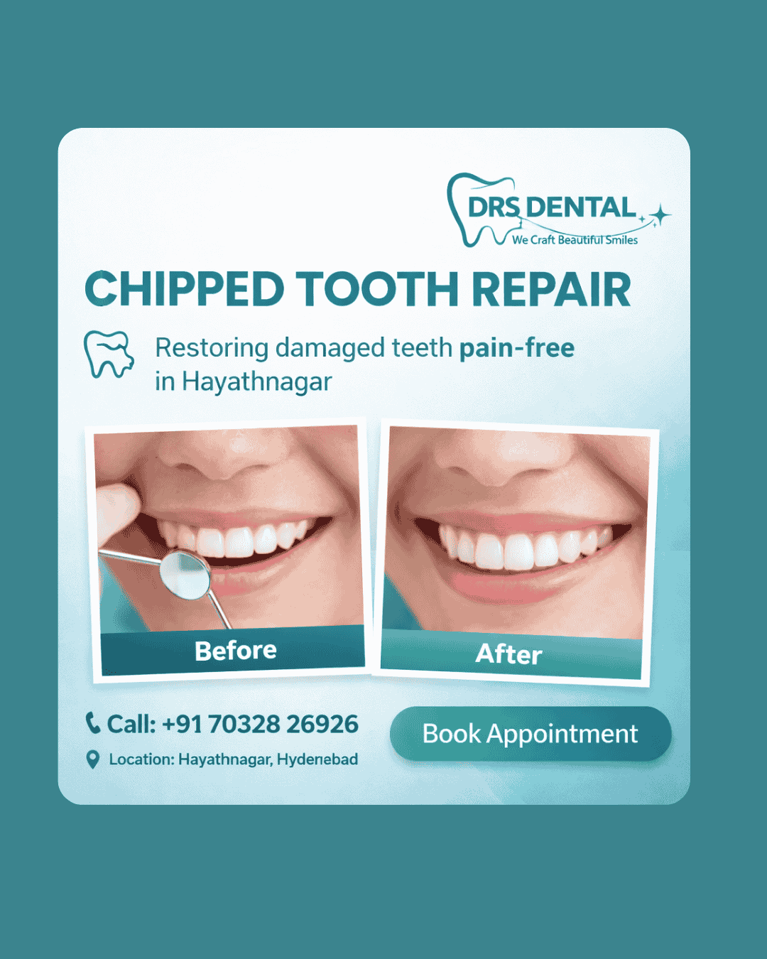 Chipped Tooth Repair in Hayathnagar