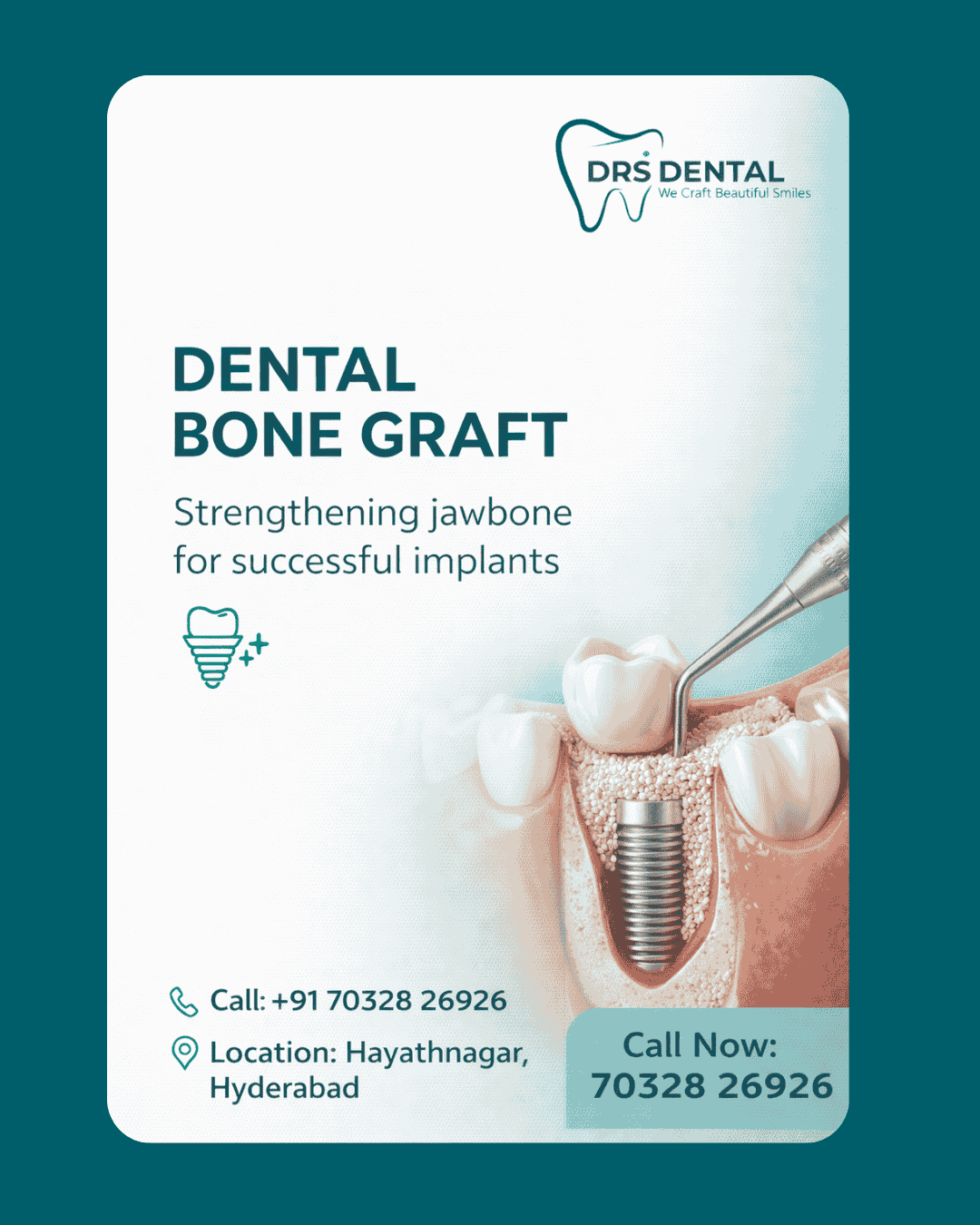 dental bone graft in Hayathnagar