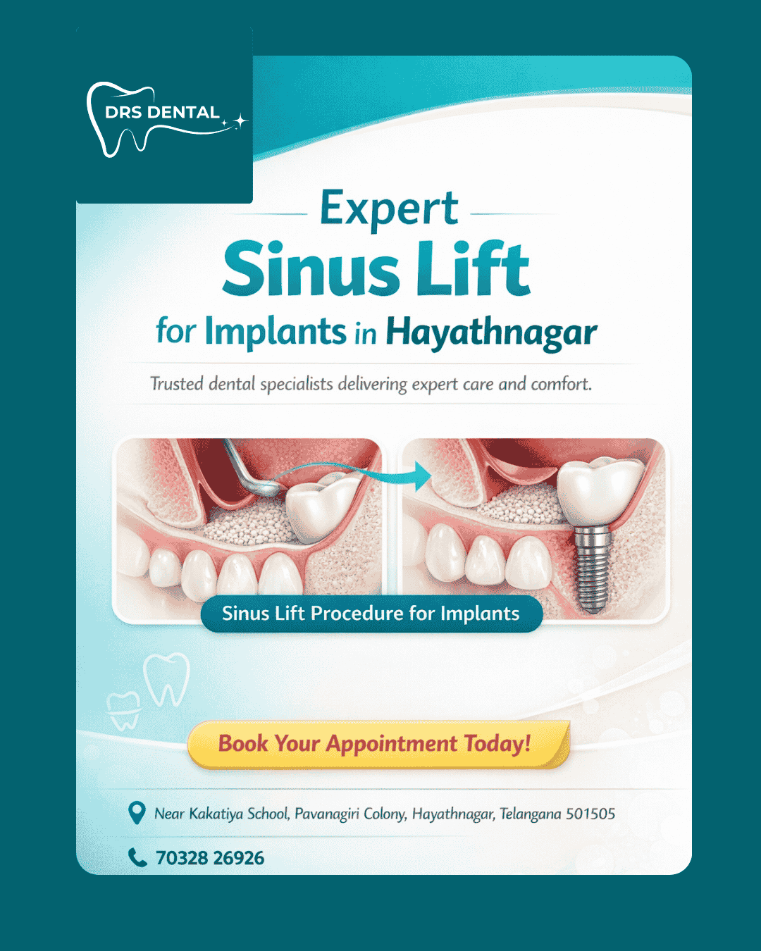 sinus lift for implants in Hayathnagar
