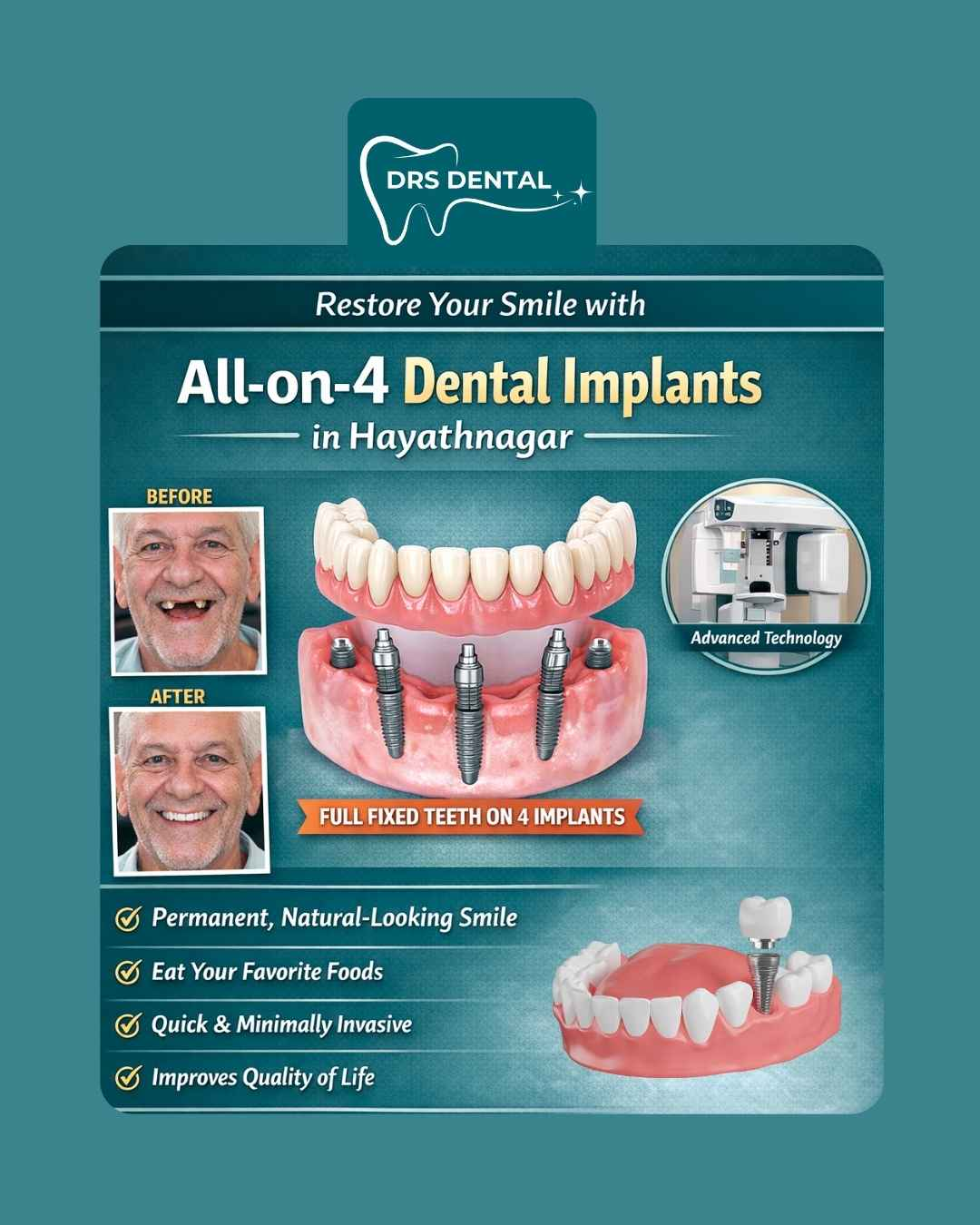 All-on-4 Dental Implants in Hayathnagar