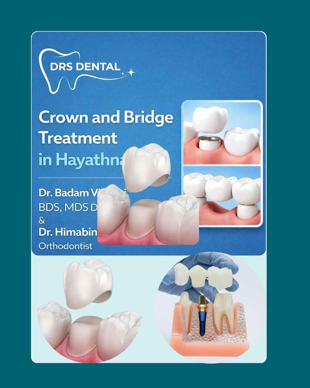 Crown and Bridge Treatment in Hayathnagar