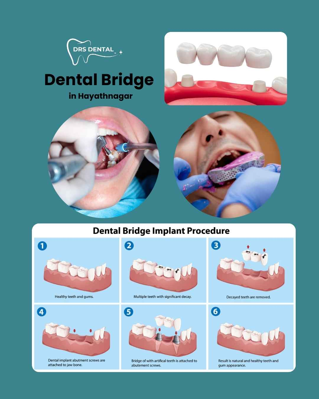 DENTAL BRIDGE IN HAYATHNAGAR