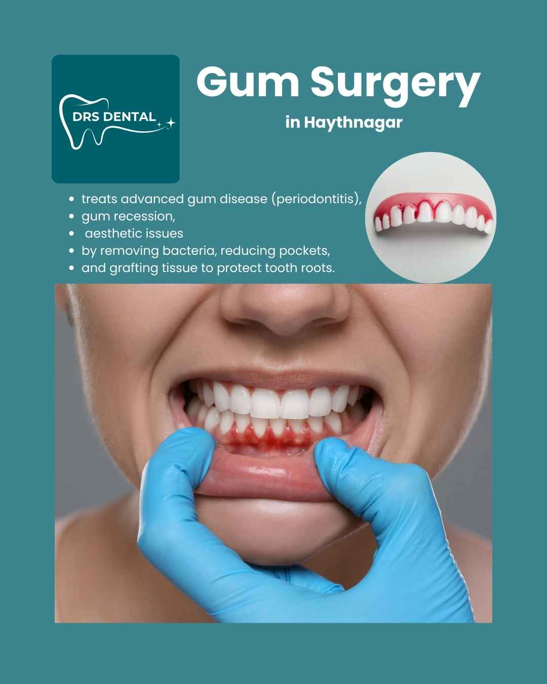 Gum surgery in Hayathnagar