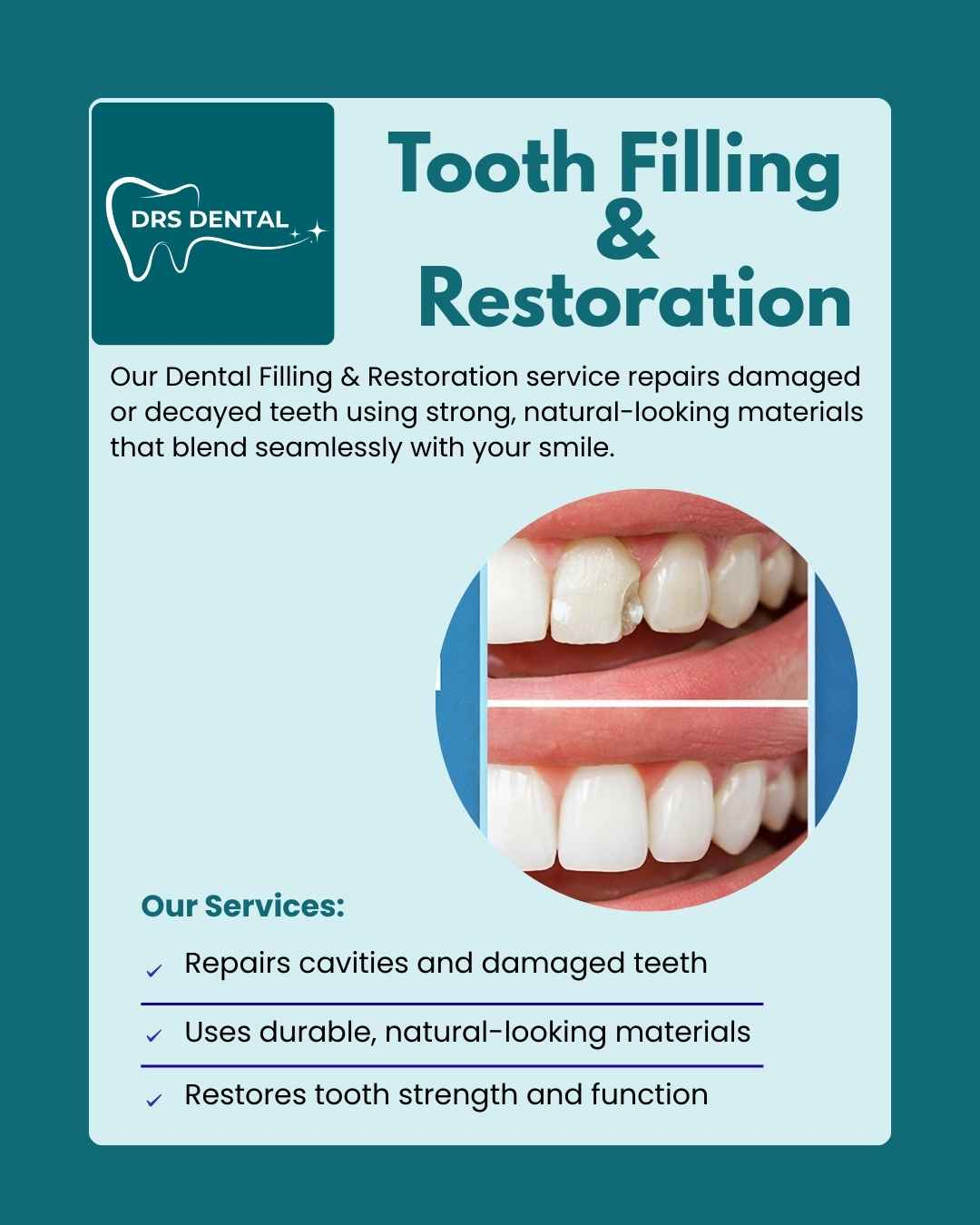 Tooth Restoration Hayathnagar